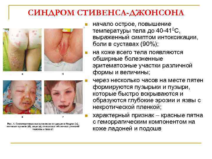 СИНДРОМ СТИВЕНСА-ДЖОНСОНА n n начало острое, повышение температуры тела до 40 -410 С, выраженный