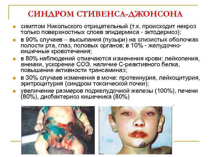 СИНДРОМ СТИВЕНСА-ДЖОНСОНА n n n симптом Никольского отрицательный (т. к. происходит некроз только поверхностных