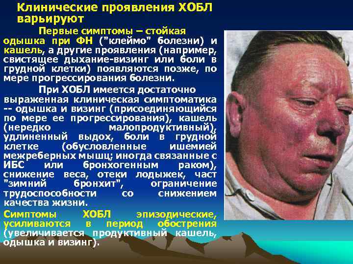 Клинические проявления ХОБЛ варьируют Первые симптомы – стойкая одышка при ФН ("клеймо" болезни) и