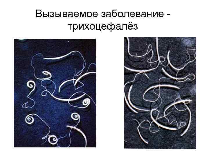 Вызываемое заболевание трихоцефалёз 