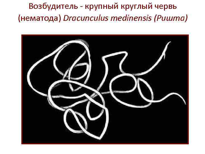 Возбудитель - крупный круглый червь (нематода) Dracunculus medinensis (Ришта) 