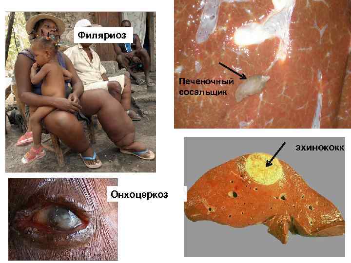 Филяриоз Печеночный сосальщик эхинококк Онхоцеркоз 