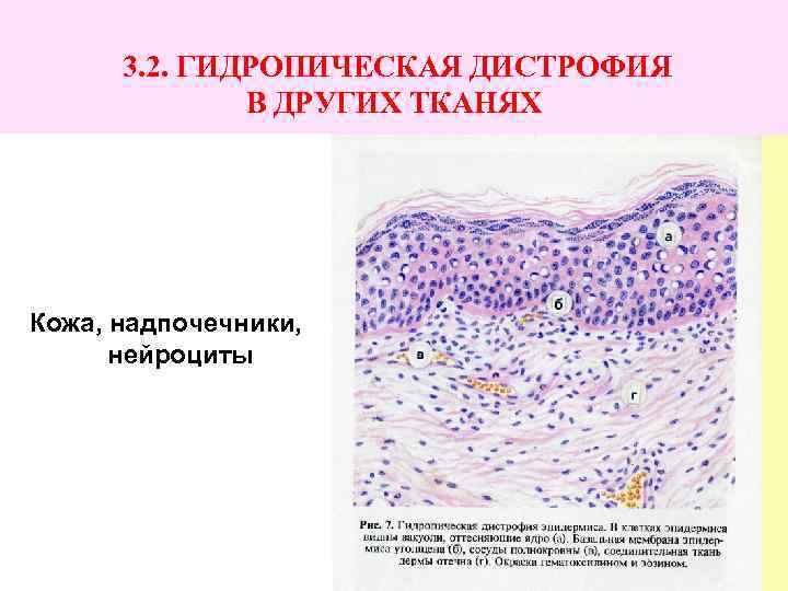 3. 2. ГИДРОПИЧЕСКАЯ ДИСТРОФИЯ В ДРУГИХ ТКАНЯХ Кожа, надпочечники, нейроциты 