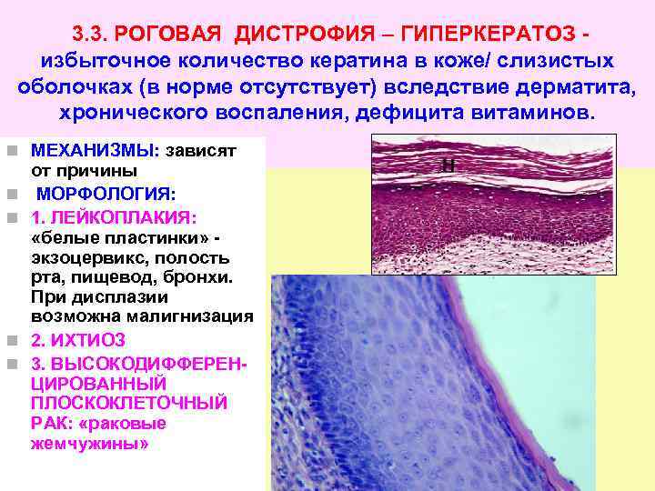 Микроскопическая картина гиалиново капельной дистрофии