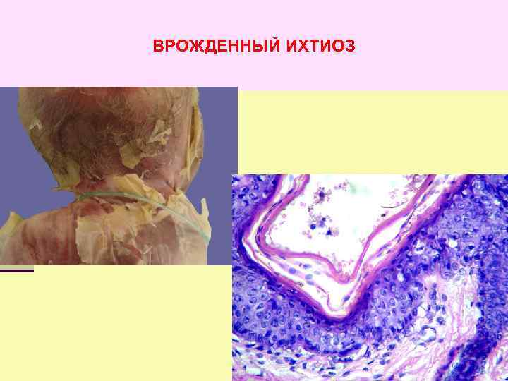 ВРОЖДЕННЫЙ ИХТИОЗ 