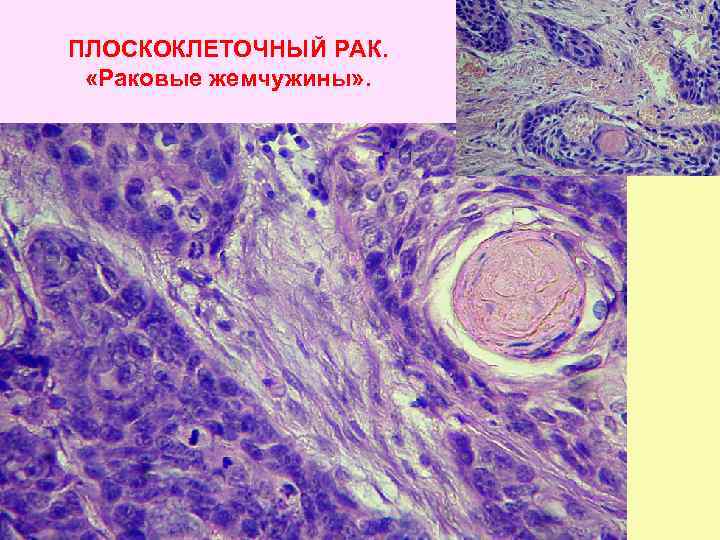 ПЛОСКОКЛЕТОЧНЫЙ РАК. «Раковые жемчужины» . 