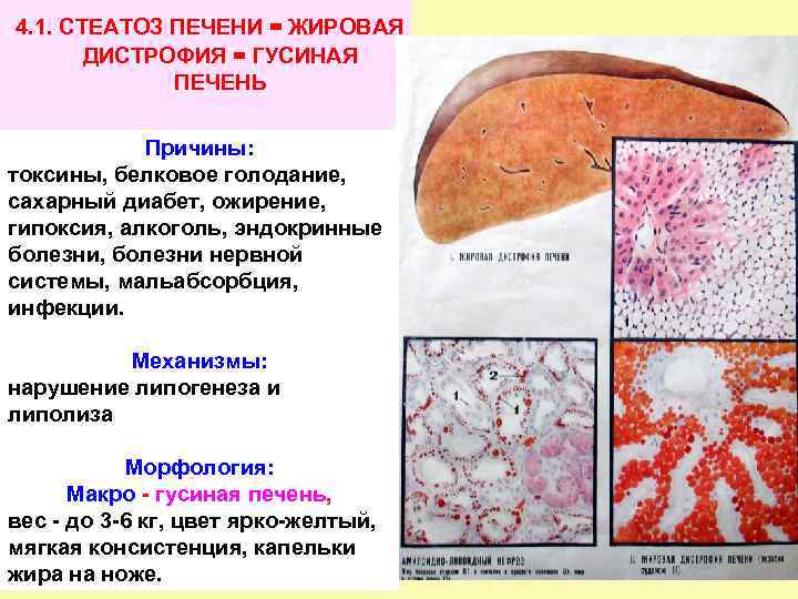 4. 1. СТЕАТОЗ ПЕЧЕНИ = ЖИРОВАЯ ДИСТРОФИЯ = ГУСИНАЯ ПЕЧЕНЬ Причины: токсины, белковое голодание,
