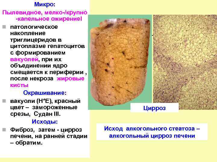 Микро: Пылевидное, мелко-/крупно -капельное ожирение. I n патологическое накопление триглицеридов в цитоплазме гепатоцитов с
