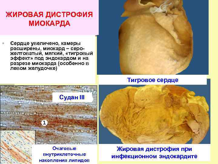 Белковая дистрофия фото