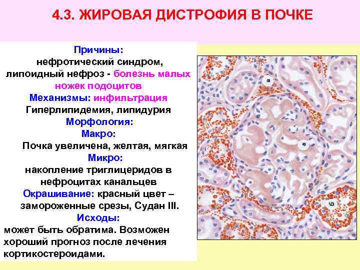 4. 3. ЖИРОВАЯ ДИСТРОФИЯ В ПОЧКЕ Причины: нефротический синдром, липоидный нефроз - болезнь малых