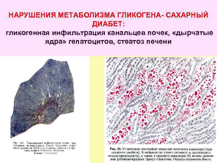 НАРУШЕНИЯ МЕТАБОЛИЗМА ГЛИКОГЕНА- САХАРНЫЙ ДИАБЕТ: гликогенная инфильтрация канальцев почек, «дырчатые ядра» гепатоцитов, стеатоз печени