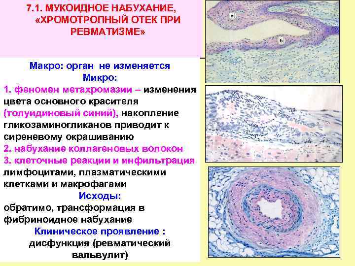 Бициллин при ревматизме схема