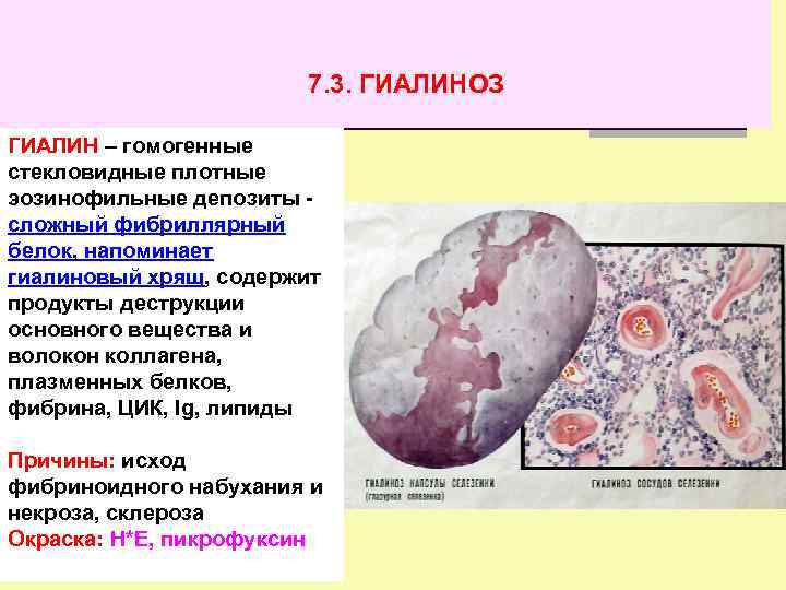 7. 3. ГИАЛИНОЗ ГИАЛИН – гомогенные стекловидные плотные эозинофильные депозиты сложный фибриллярный белок, напоминает