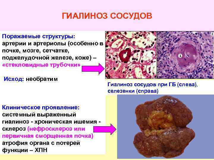 ГИАЛИНОЗ СОСУДОВ Поражаемые структуры: артерии и артериолы (особенно в почке, мозге, сетчатке, поджелудочной железе,