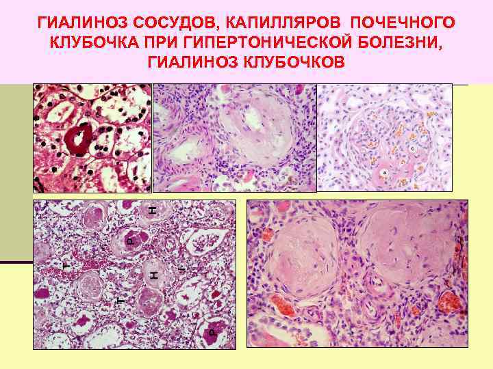 ГИАЛИНОЗ СОСУДОВ, КАПИЛЛЯРОВ ПОЧЕЧНОГО КЛУБОЧКА ПРИ ГИПЕРТОНИЧЕСКОЙ БОЛЕЗНИ, ГИАЛИНОЗ КЛУБОЧКОВ 