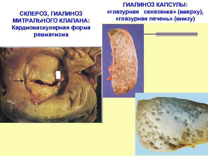 СКЛЕРОЗ, ГИАЛИНОЗ МИТРАЛЬНОГО КЛАПАНА: Кардиоваскулярная форма ревматизма ГИАЛИНОЗ КАПСУЛЫ: «глазурная селезенка» (вверху), «глазурная печень»