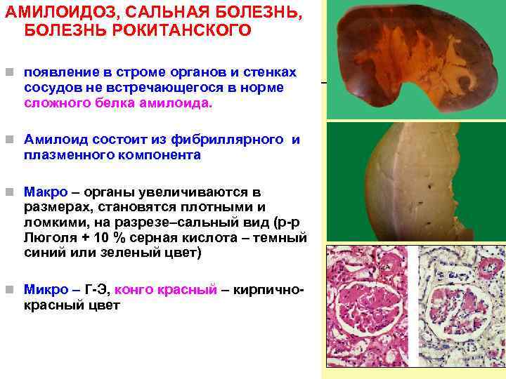 АМИЛОИДОЗ, САЛЬНАЯ БОЛЕЗНЬ, БОЛЕЗНЬ РОКИТАНСКОГО n появление в строме органов и стенках сосудов не