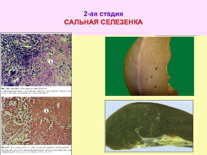 2 -ая стадия САЛЬНАЯ СЕЛЕЗЕНКА 