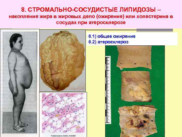 8. СТРОМАЛЬНО-СОСУДИСТЫЕ ЛИПИДОЗЫ – накопление жира в жировых депо (ожирение) или холестерина в сосудах