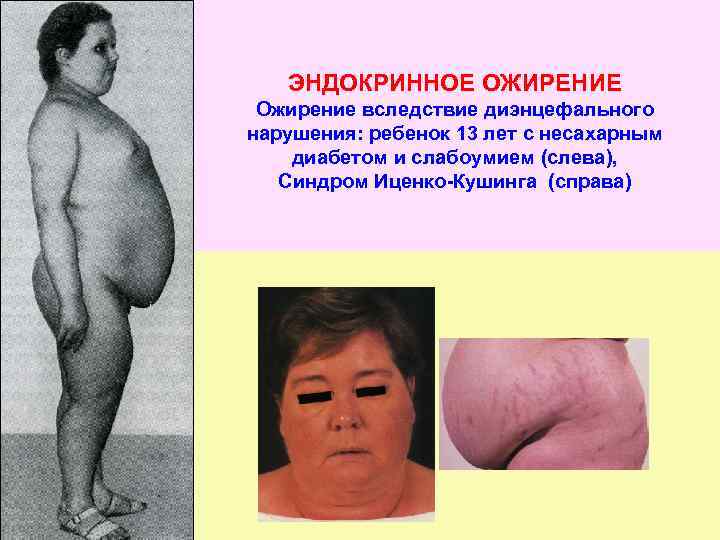 ЭНДОКРИННОЕ ОЖИРЕНИЕ Ожирение вследствие диэнцефального нарушения: ребенок 13 лет с несахарным диабетом и слабоумием