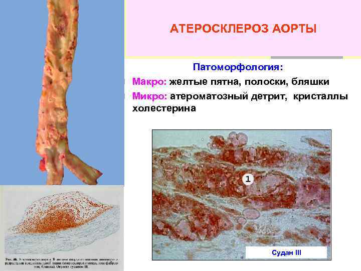 АТЕРОСКЛЕРОЗ АОРТЫ Патоморфология: n Макро: желтые пятна, полоски, бляшки n Микро: атероматозный детрит, кристаллы