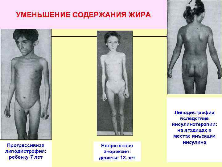УМЕНЬШЕНИЕ СОДЕРЖАНИЯ ЖИРА Прогрессивная липодистрофия: ребенку 7 лет Неврогенная анорексия: девочке 13 лет Липодистрофия