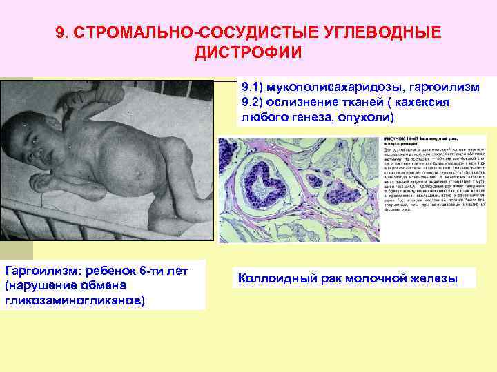 9. СТРОМАЛЬНО-СОСУДИСТЫЕ УГЛЕВОДНЫЕ ДИСТРОФИИ 9. 1) мукополисахаридозы, гаргоилизм 9. 2) ослизнение тканей ( кахексия