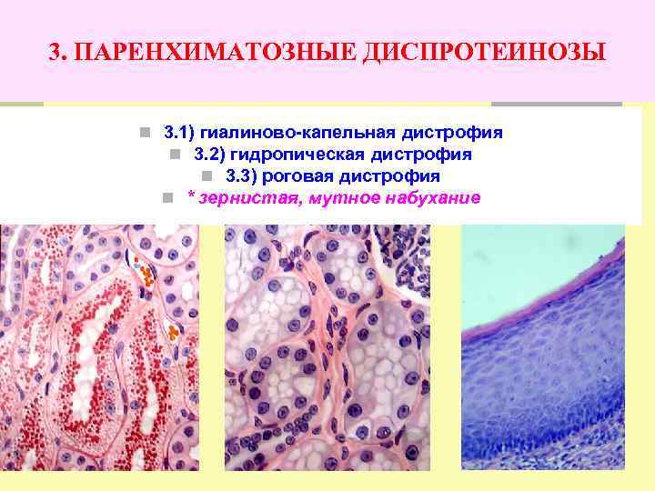 Роговая дистрофия. Гидропическая и гиалиново капельная дистрофия. Внешний вид гиалиново капельной дистрофии. Белковая дистрофия гиалиново-капельная. Роговая белковая дистрофия микроскопия.