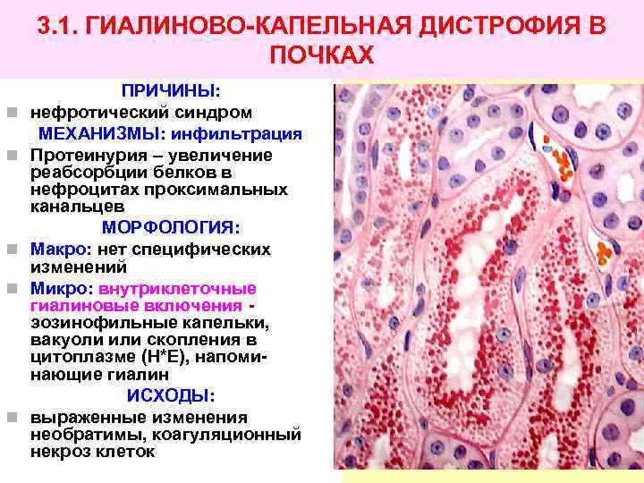 Гиалиново капельная дистрофия