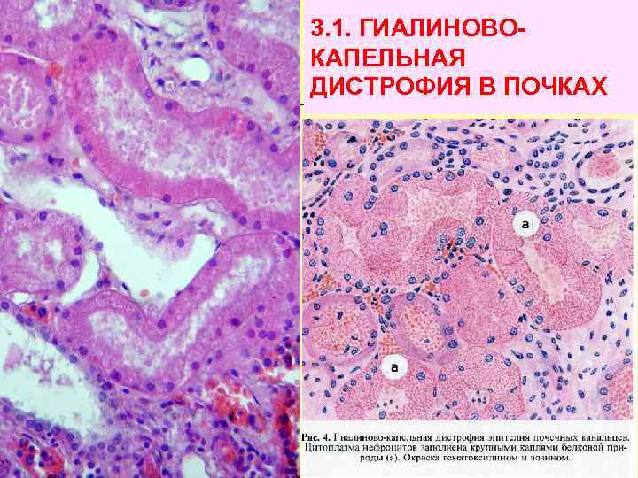 3. 1. ГИАЛИНОВОКАПЕЛЬНАЯ ДИСТРОФИЯ В ПОЧКАХ 