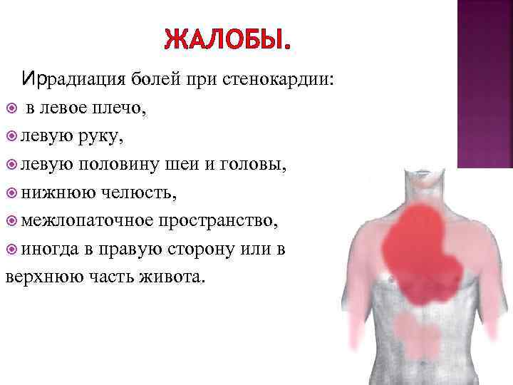 ЖАЛОБЫ. Иррадиация болей при стенокардии: в левое плечо, левую руку, левую половину шеи и