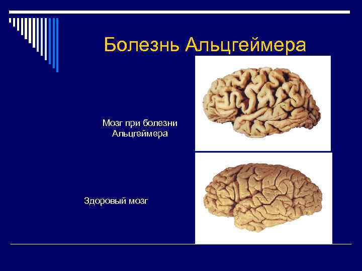 Болезнь Альцгеймера Мозг при болезни Альцгеймера Здоровый мозг 