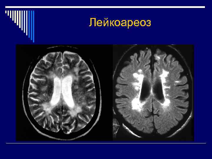 Лейкоареоз головного мозга