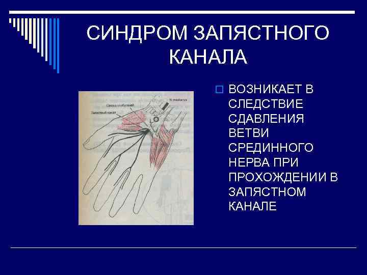 СИНДРОМ ЗАПЯСТНОГО КАНАЛА o ВОЗНИКАЕТ В СЛЕДСТВИЕ СДАВЛЕНИЯ ВЕТВИ СРЕДИННОГО НЕРВА ПРИ ПРОХОЖДЕНИИ В