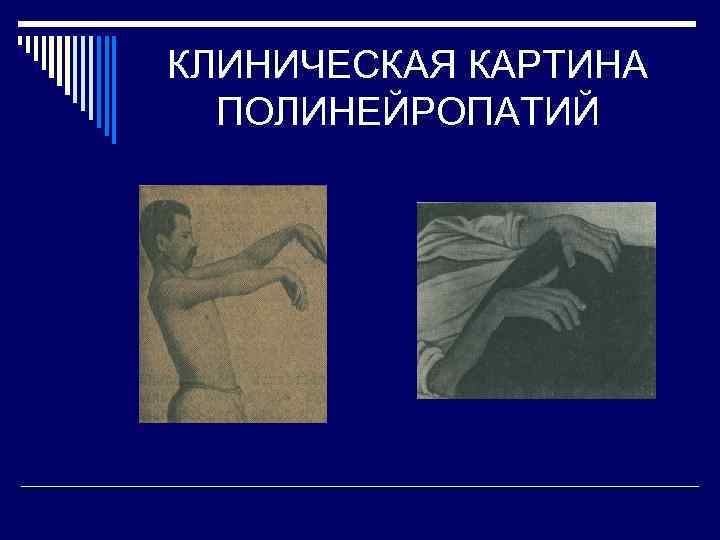 КЛИНИЧЕСКАЯ КАРТИНА ПОЛИНЕЙРОПАТИЙ 
