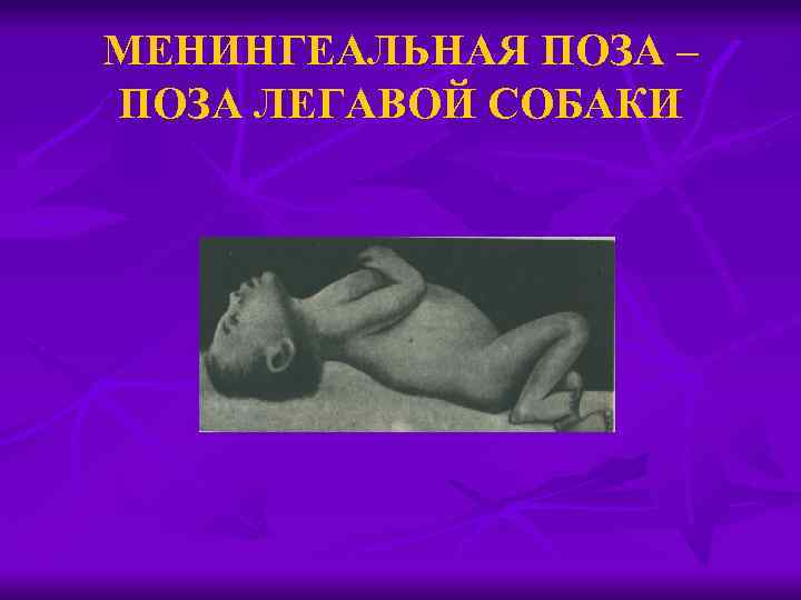 МЕНИНГЕАЛЬНАЯ ПОЗА – ПОЗА ЛЕГАВОЙ СОБАКИ 