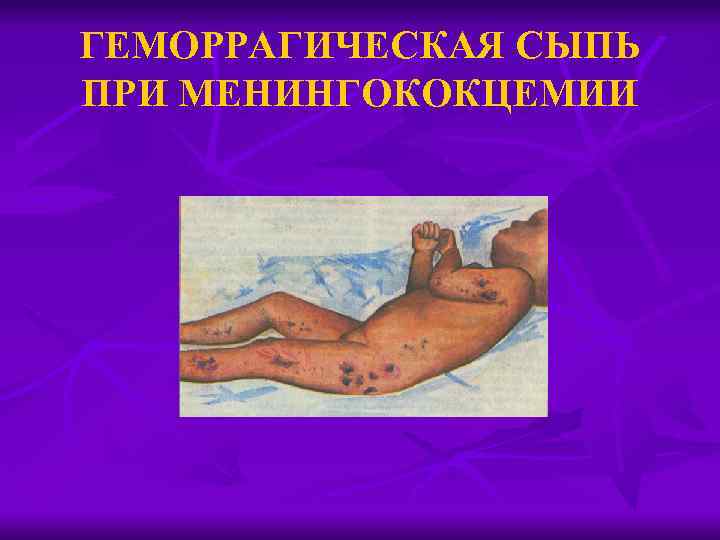 ГЕМОРРАГИЧЕСКАЯ СЫПЬ ПРИ МЕНИНГОКОКЦЕМИИ 