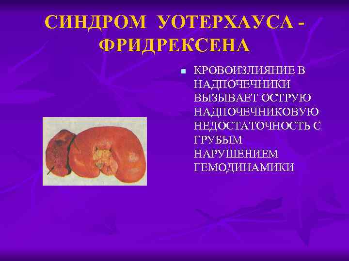 СИНДРОМ УОТЕРХАУСА ФРИДРЕКСЕНА n КРОВОИЗЛИЯНИЕ В НАДПОЧЕЧНИКИ ВЫЗЫВАЕТ ОСТРУЮ НАДПОЧЕЧНИКОВУЮ НЕДОСТАТОЧНОСТЬ С ГРУБЫМ НАРУШЕНИЕМ