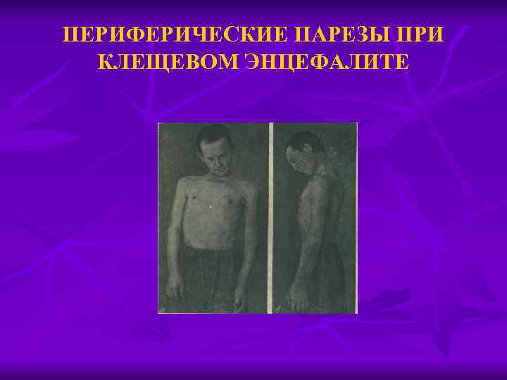 ПЕРИФЕРИЧЕСКИЕ ПАРЕЗЫ ПРИ КЛЕЩЕВОМ ЭНЦЕФАЛИТЕ 
