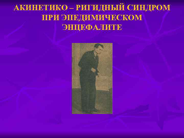 АКИНЕТИКО – РИГИДНЫЙ СИНДРОМ ПРИ ЭПЕДИМИЧЕСКОМ ЭНЦЕФАЛИТЕ 