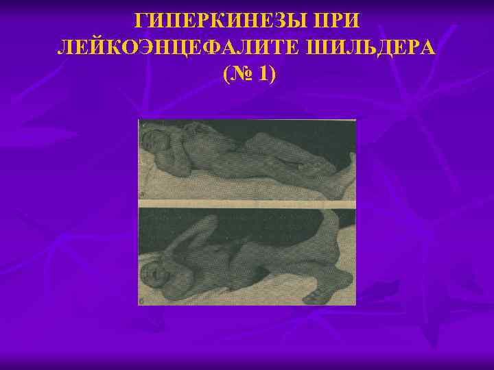 ГИПЕРКИНЕЗЫ ПРИ ЛЕЙКОЭНЦЕФАЛИТЕ ШИЛЬДЕРА (№ 1) 
