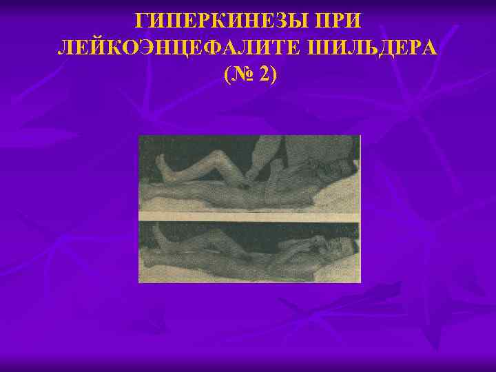 ГИПЕРКИНЕЗЫ ПРИ ЛЕЙКОЭНЦЕФАЛИТЕ ШИЛЬДЕРА (№ 2) 
