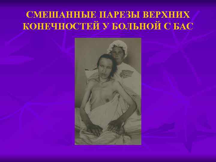 СМЕШАННЫЕ ПАРЕЗЫ ВЕРХНИХ КОНЕЧНОСТЕЙ У БОЛЬНОЙ С БАС 