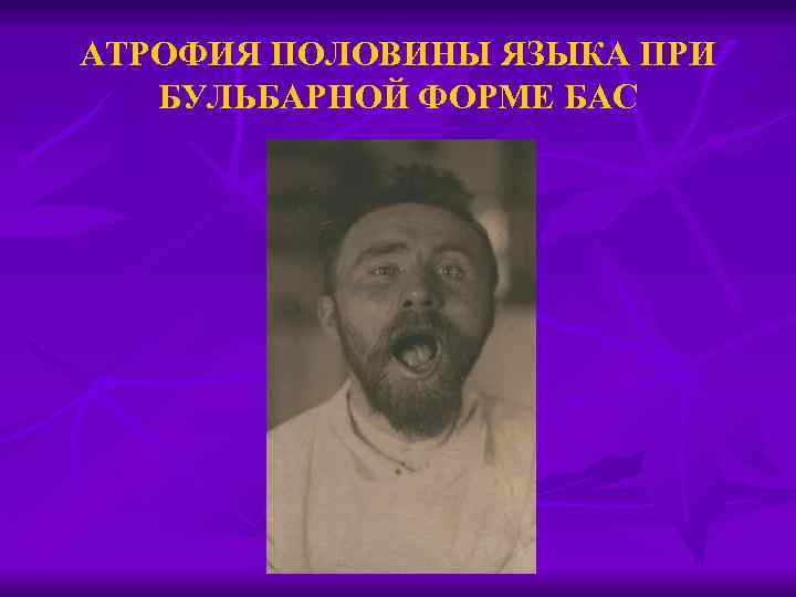 АТРОФИЯ ПОЛОВИНЫ ЯЗЫКА ПРИ БУЛЬБАРНОЙ ФОРМЕ БАС 