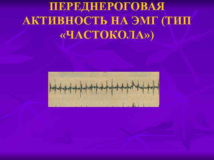 ПЕРЕДНЕРОГОВАЯ АКТИВНОСТЬ НА ЭМГ (ТИП «ЧАСТОКОЛА» ) 