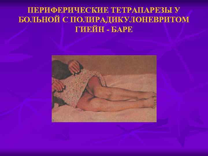ПЕРИФЕРИЧЕСКИЕ ТЕТРАПАРЕЗЫ У БОЛЬНОЙ С ПОЛИРАДИКУЛОНЕВРИТОМ ГИЕЙН - БАРЕ 