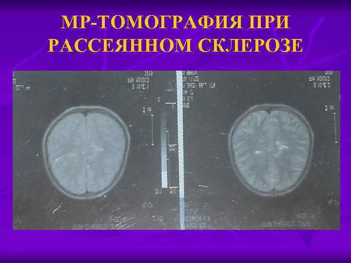 МР-ТОМОГРАФИЯ ПРИ РАССЕЯННОМ СКЛЕРОЗЕ 