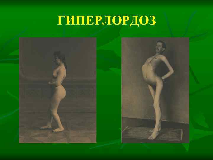 ГИПЕРЛОРДОЗ 