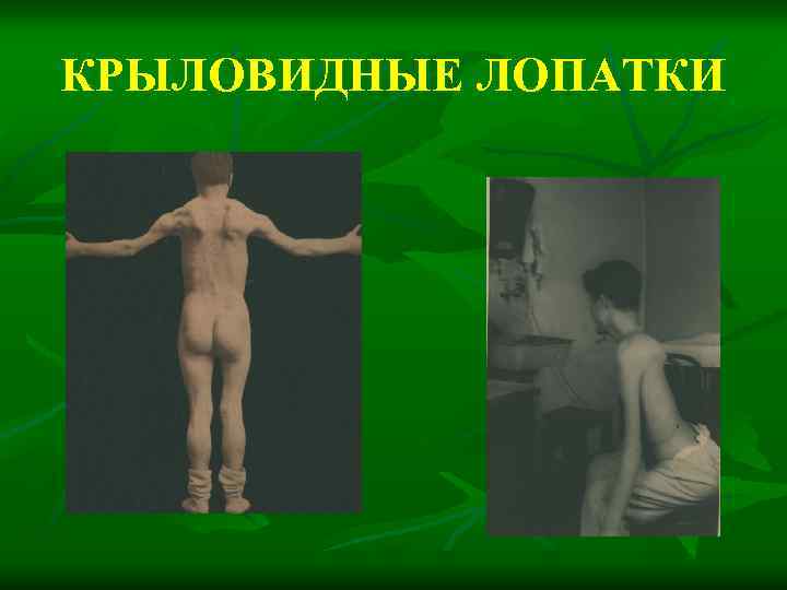 КРЫЛОВИДНЫЕ ЛОПАТКИ 