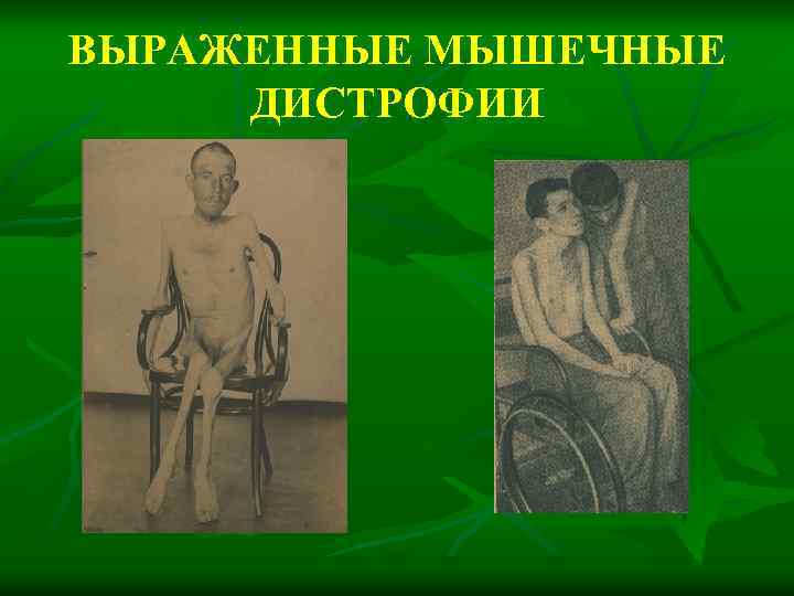 ВЫРАЖЕННЫЕ МЫШЕЧНЫЕ ДИСТРОФИИ 